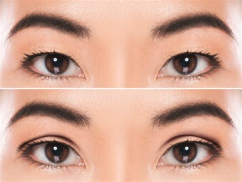 A <b>double</b> <b>eyelid</b> has a visible crease. . Botched double eyelid surgery reddit